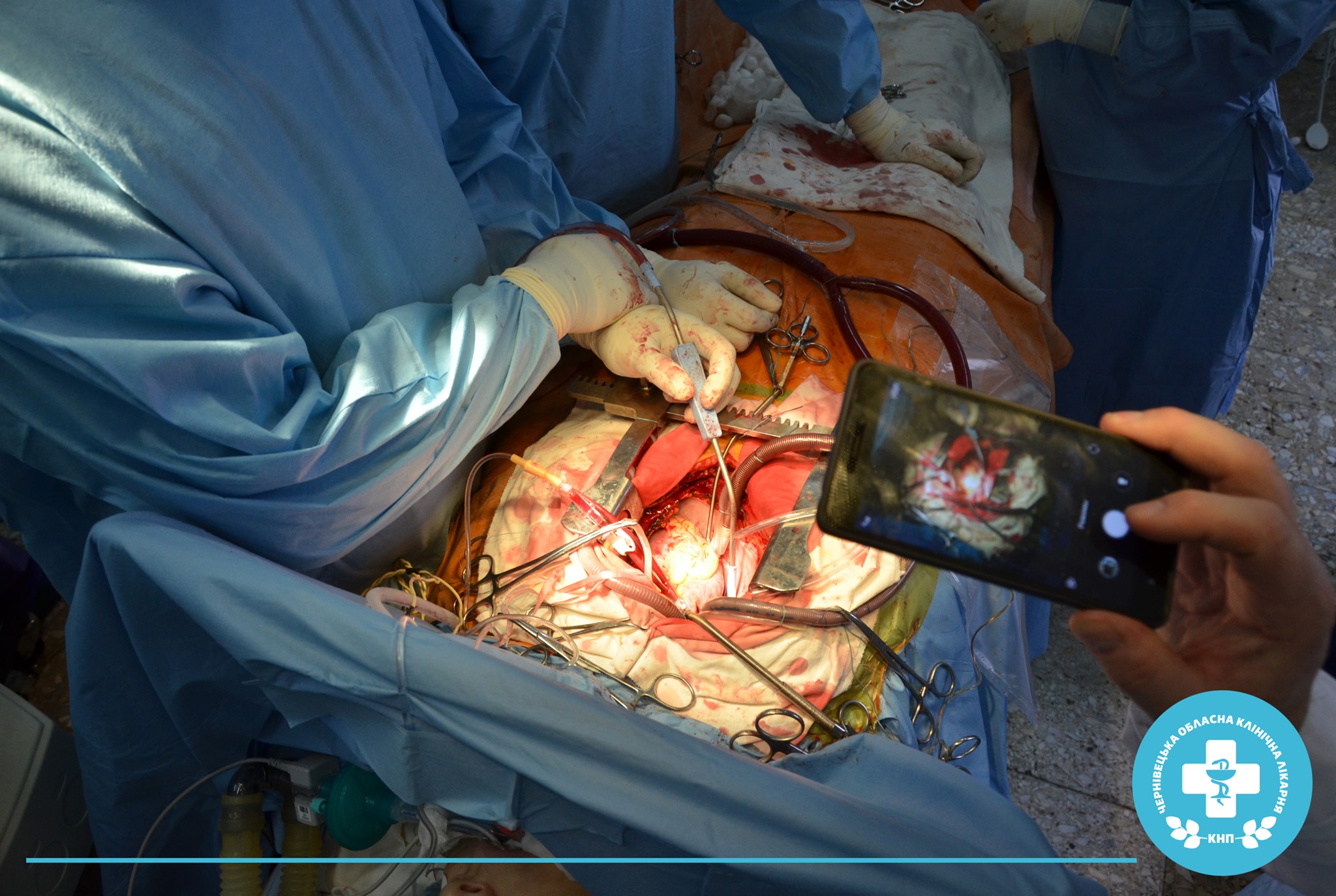 Серце зупиняють на 60-100 хвилин, а кров продовжує качати апарат штучного кровообігу: на Буковині започаткували кардіохірургію