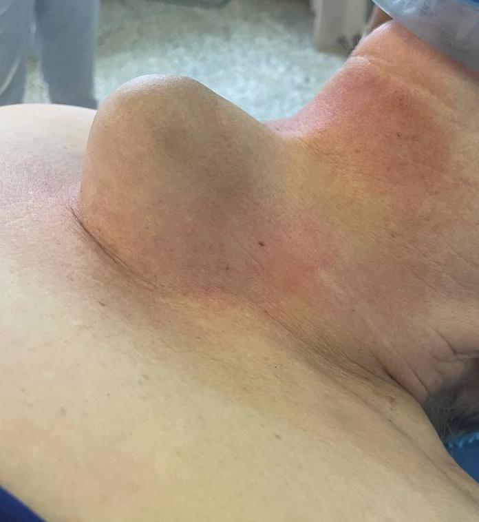 Хірурги Чернівецької обласної лікарні видалили пацієнтці пухлину щитовидки, розміром 20 см 