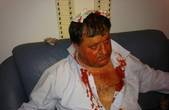 «Регіонали» жорстоко побили кастетом депутата від опозиції (коментар Анатолія Гриценка)