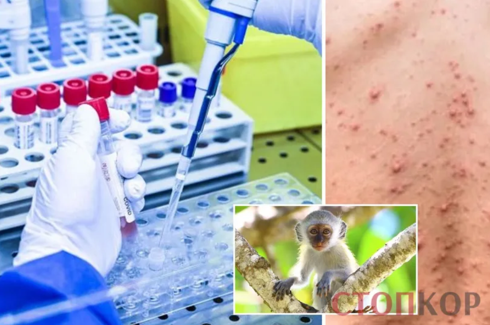 Що варто знати про вірус мавпячої віспи