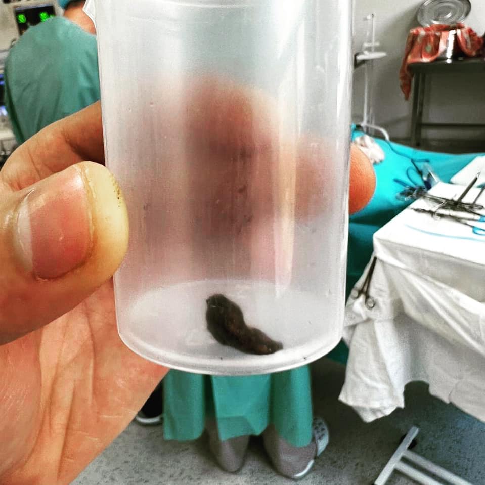 Вилучили уламок з печінки: хірурги Буковинського онкоцентру успішно прооперували військовослужбовця ЗСУ, який підірвався на міні 