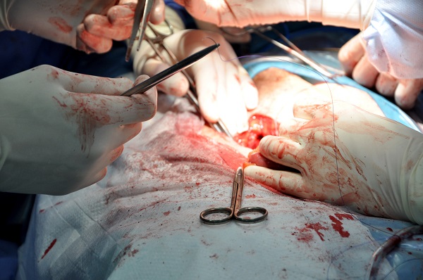 У Чернівецькій обласній лікарні хворому на рак пацієнту зробили новий сечовий міхур з його власного кишківника